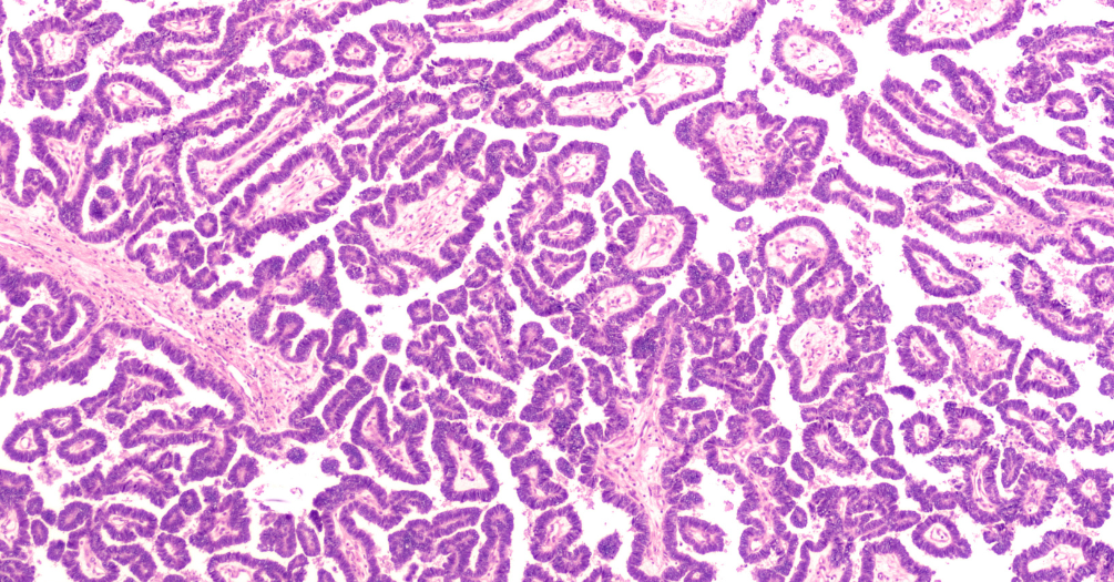 Micrograph of a serous papillary carcinoma (adenocarcinoma) of an ovary.