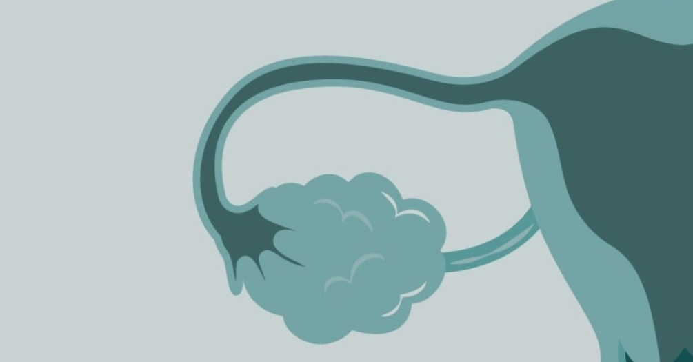 An illustration of an ovary with ovarian cancer.